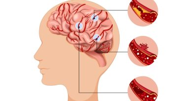 Stroke Jadi Penyebab Kematian Tertinggi di Indonesia