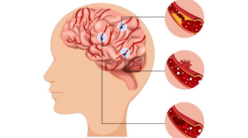 Stroke Jadi Penyebab Kematian Tertinggi di Indonesia